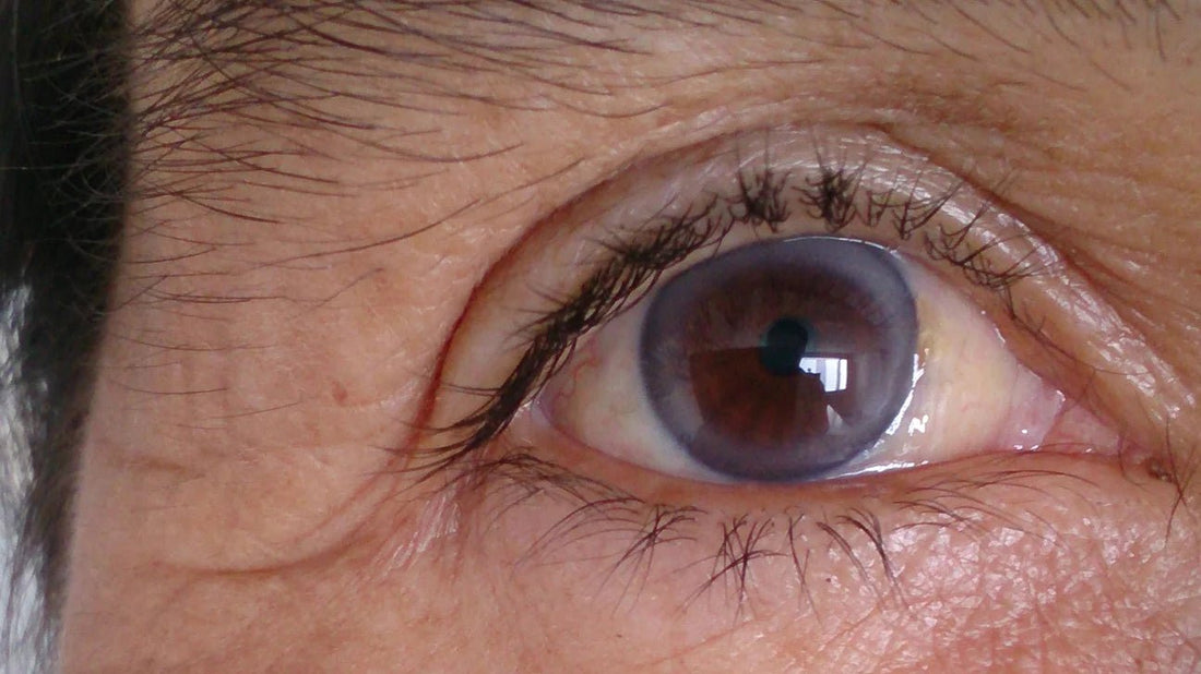 Concerns about a Blue Ring around the Eye - We Love Spells